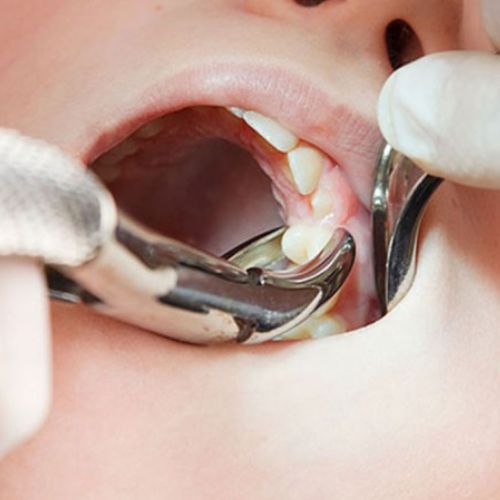 انواع فورسپس دندانپزشکی