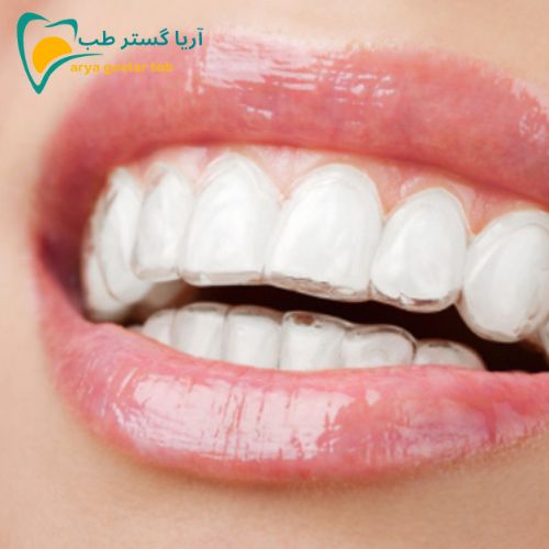 انواع نایت گارد دندانپزشکی