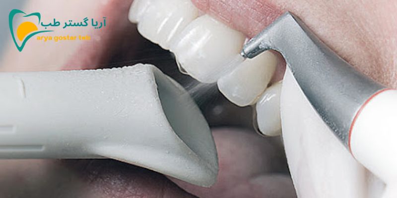 دستگاه سندبلاست دندانپزشکی چه کاربردی در دندانپزشکی دارد؟ 1 سندبلاست دندانپزشکی چیست؟