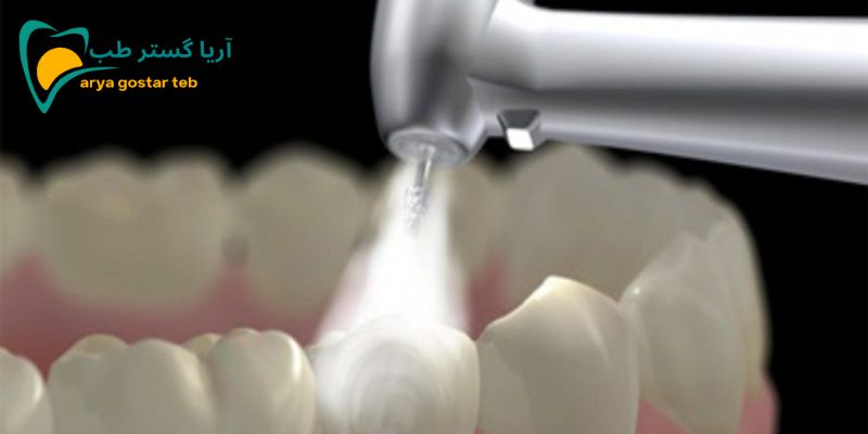 دستگاه سندبلاست دندانپزشکی چه کاربردی در دندانپزشکی دارد؟ 5 مزایای استفاده از سندبلاست دندانسازی چیست؟