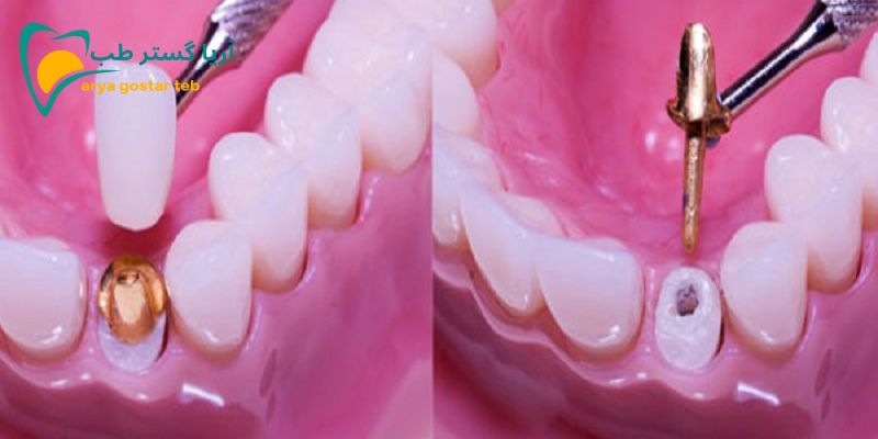 انواع پست دندان چه کاربردی در دندانپزشکی دارند؟ 5 پست و کور دندان
