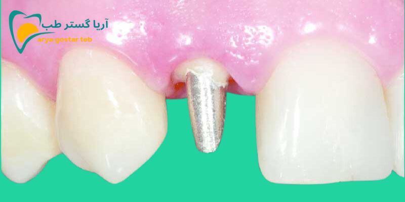 انواع پست دندان چه کاربردی در دندانپزشکی دارند؟ 1 پست و کور دندان چیست؟