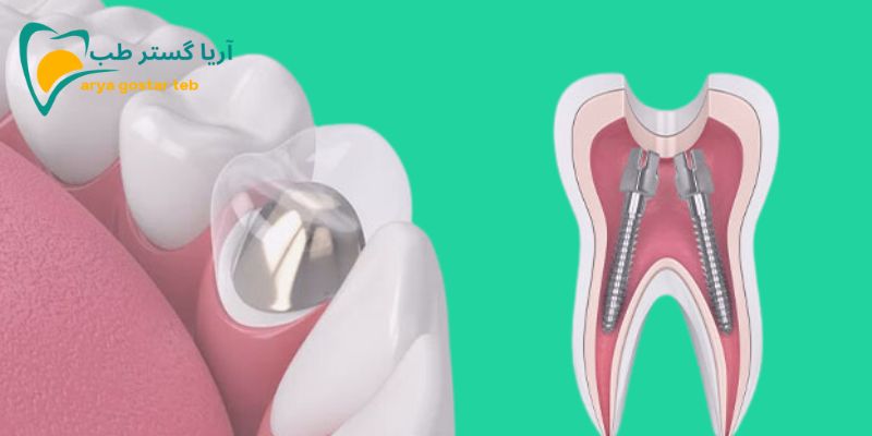 انواع پست دندان چه کاربردی در دندانپزشکی دارند؟ 3 کاربرد پست دندان