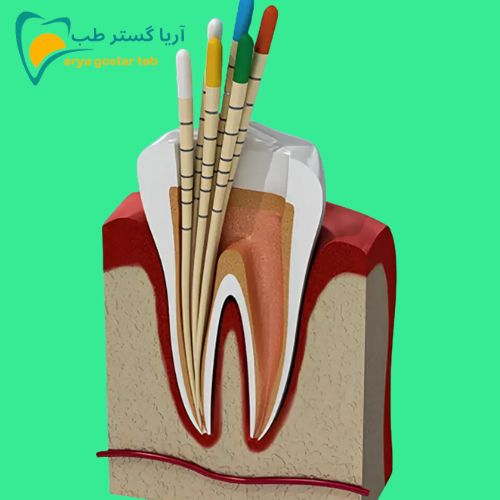 کاربرد گوتا پرکا در دندانپزشکی